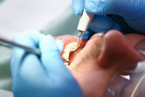 Best Dentist for Tooth Abscess  in Bunk Foss, WA