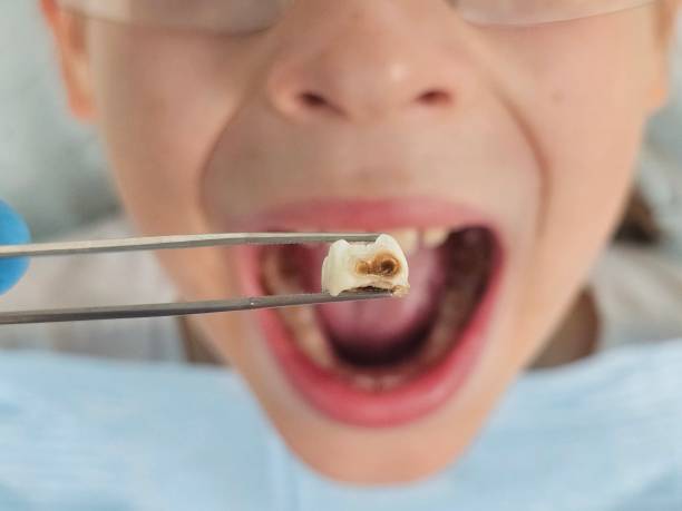 Best Knocked-Out Tooth Emergency  in Bunk Foss, WA